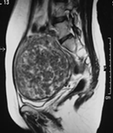 MRI Scan Fibroid-1