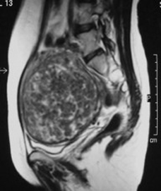 MRI-Scan-Fibroid-192x228 (1)