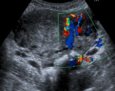 Ultrasound scan of pelvic varicose veins (1)