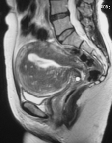 MRI Adenomyosis (1)