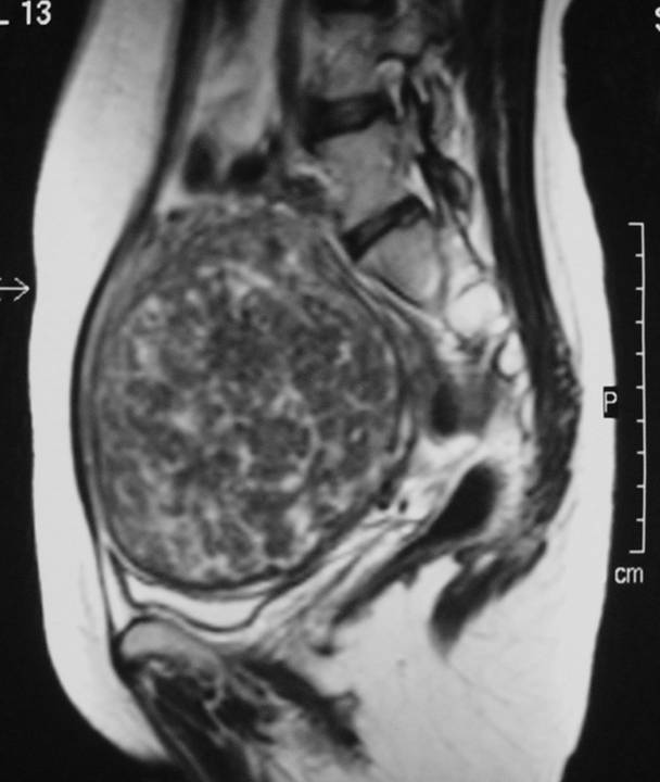 MRI Scan Fibroid